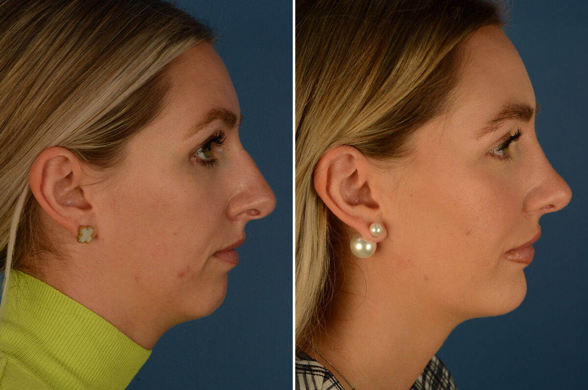 Chin Implant Before and After Photos in Naples, FL, Patient 29580