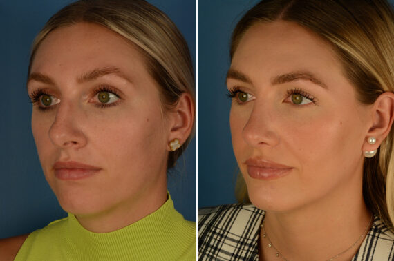 Chin Implant Before and After Photos in Naples, FL, Patient 29580