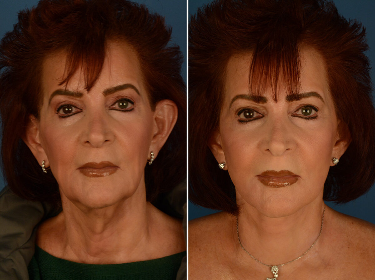 The UpLift™ Lower Face and Neck Lift Before and After Photos in Naples, FL, Patient 29515