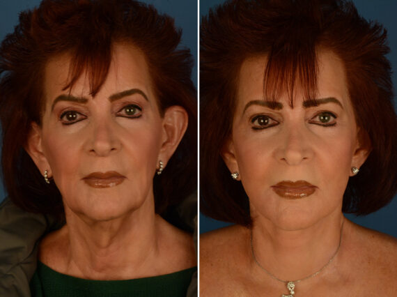 The UpLift™ Lower Face and Neck Lift Before and After Photos in Naples, FL, Patient 29515