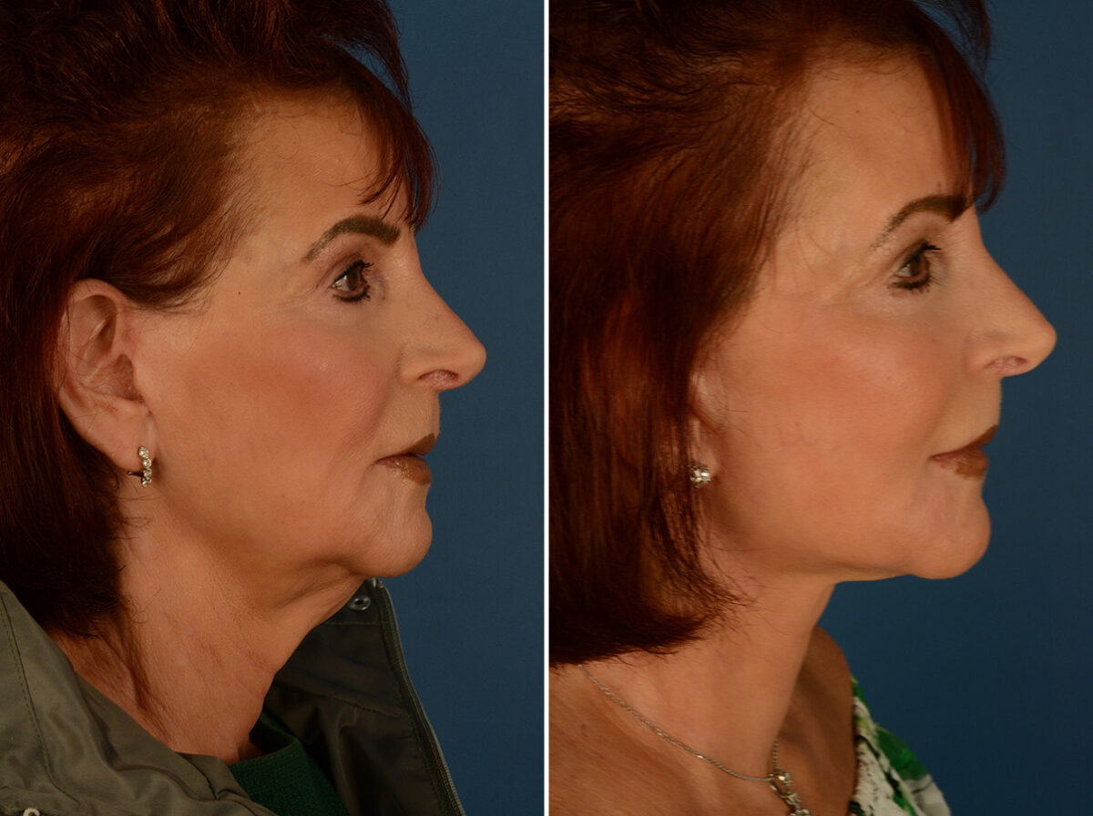 The UpLift™ Lower Face and Neck Lift Before and After Photos in Naples, FL, Patient 29515