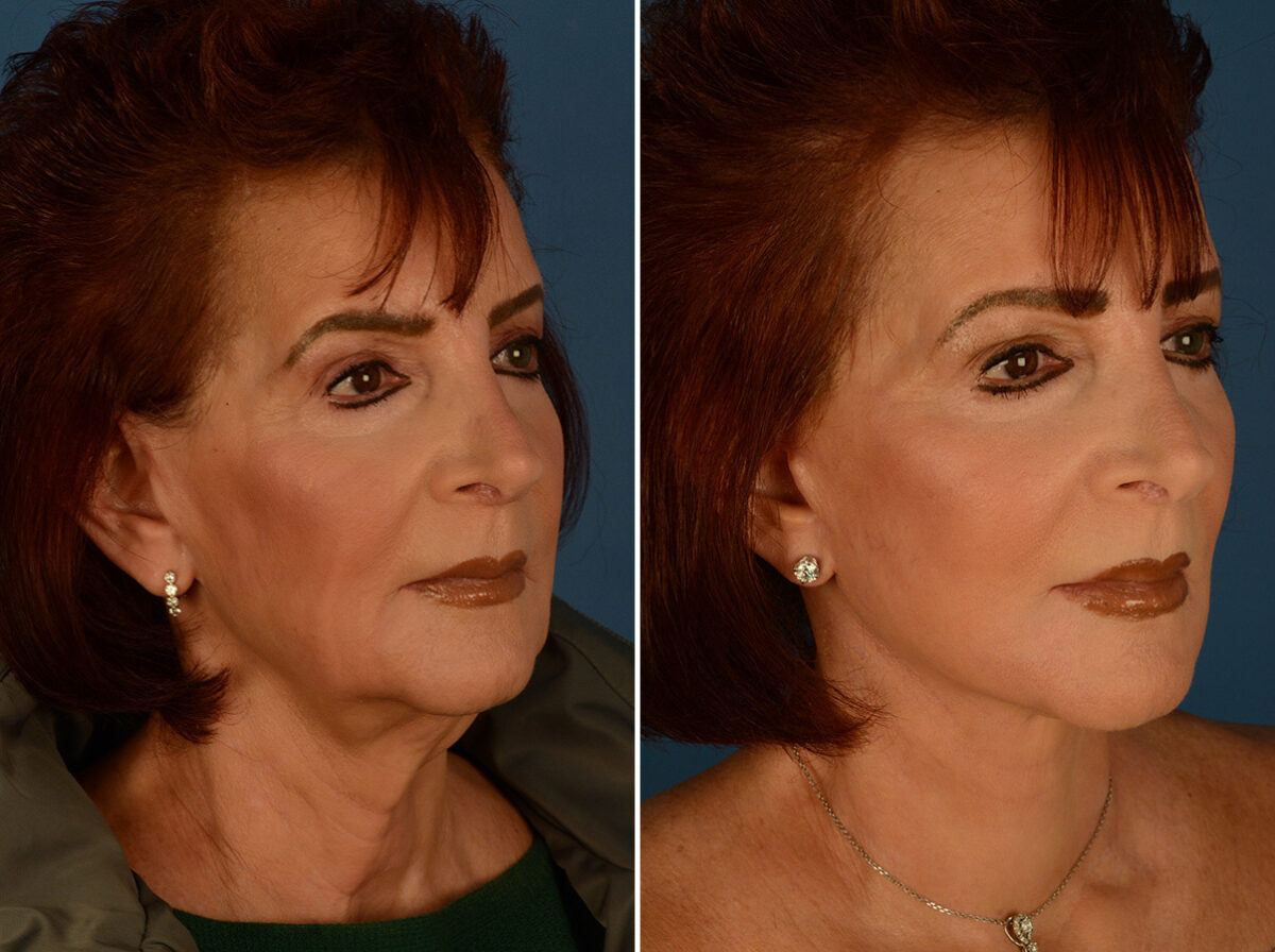 The UpLift™ Lower Face and Neck Lift Before and After Photos in Naples, FL, Patient 29515