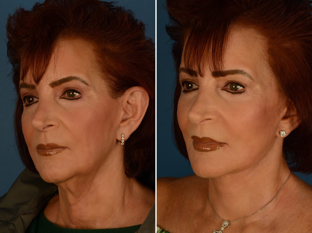 The UpLift™ Lower Face and Neck Lift Before and After Photos in Naples, FL, Patient 29515