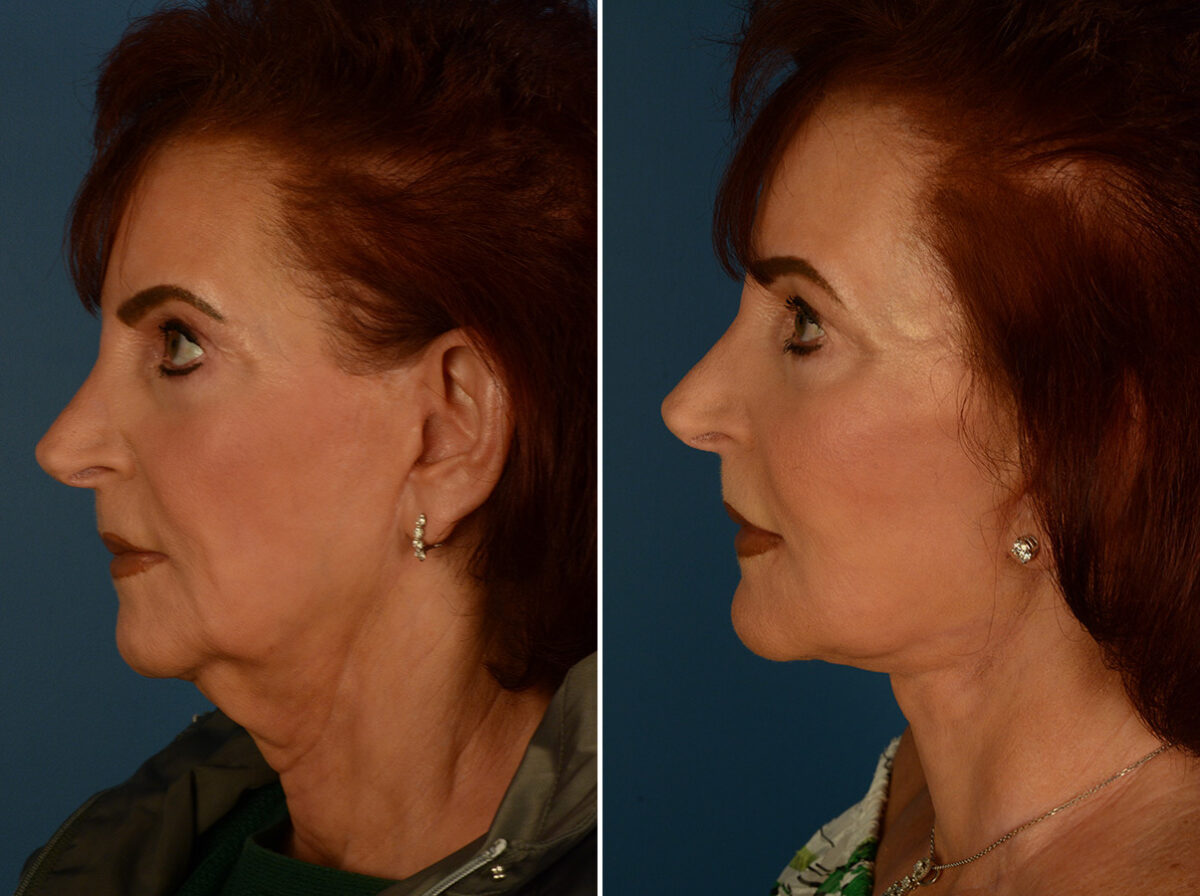 The UpLift™ Lower Face and Neck Lift Before and After Photos in Naples, FL, Patient 29515