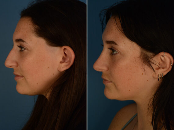 Rhinoplasty Before and After Photos in Naples, FL, Patient 29794