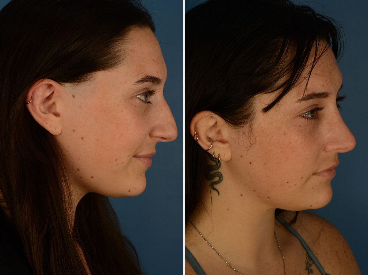 Rhinoplasty Before and After Photos in Naples, FL, Patient 29794