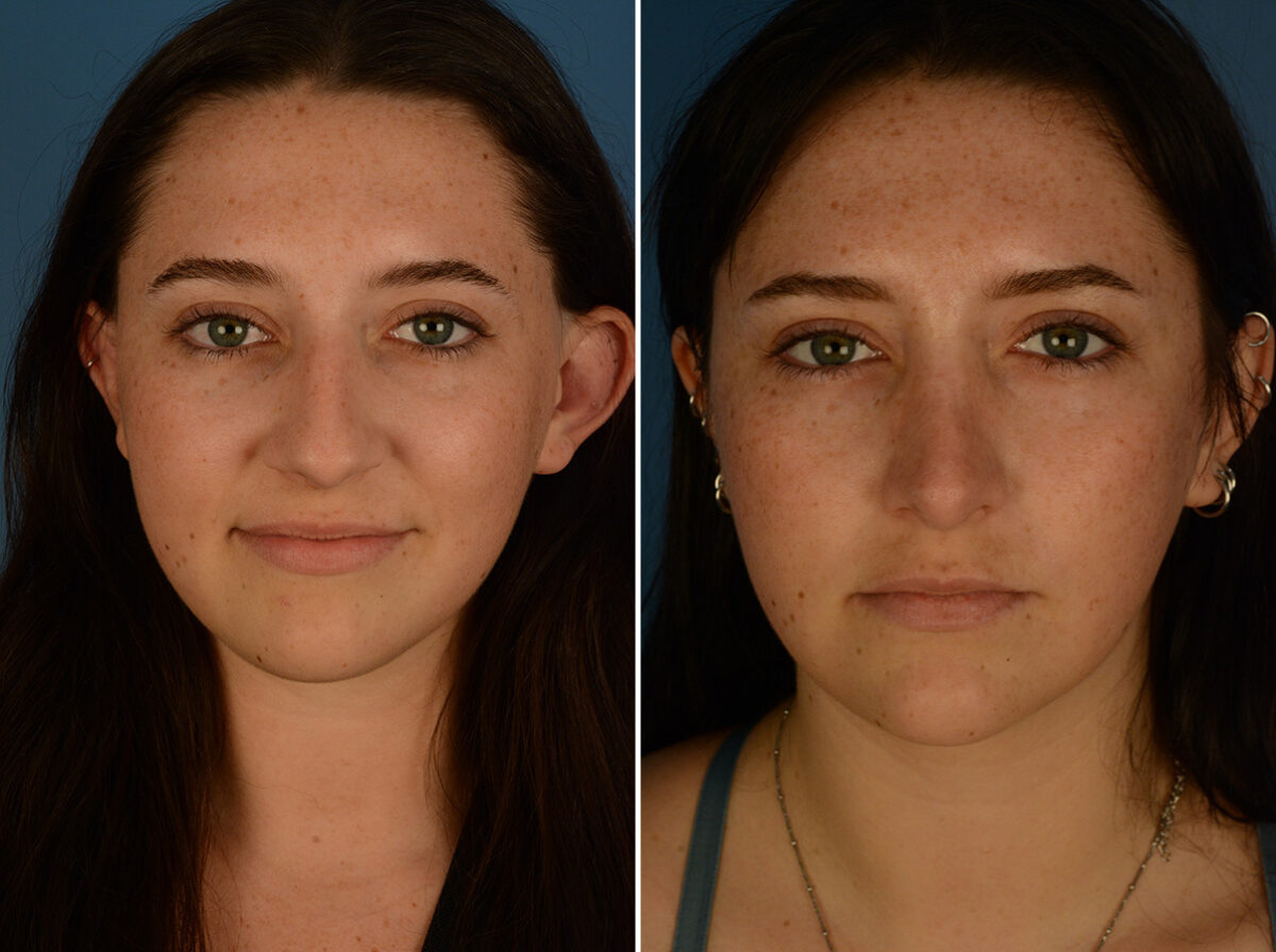 Rhinoplasty Before and After Photos in Naples, FL, Patient 29794