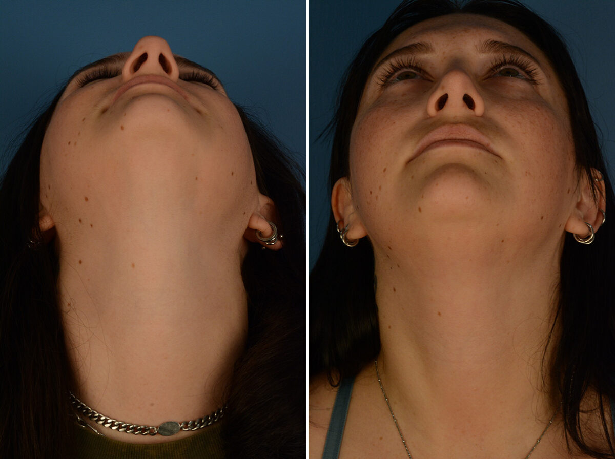 Rhinoplasty Before and After Photos in Naples, FL, Patient 29794