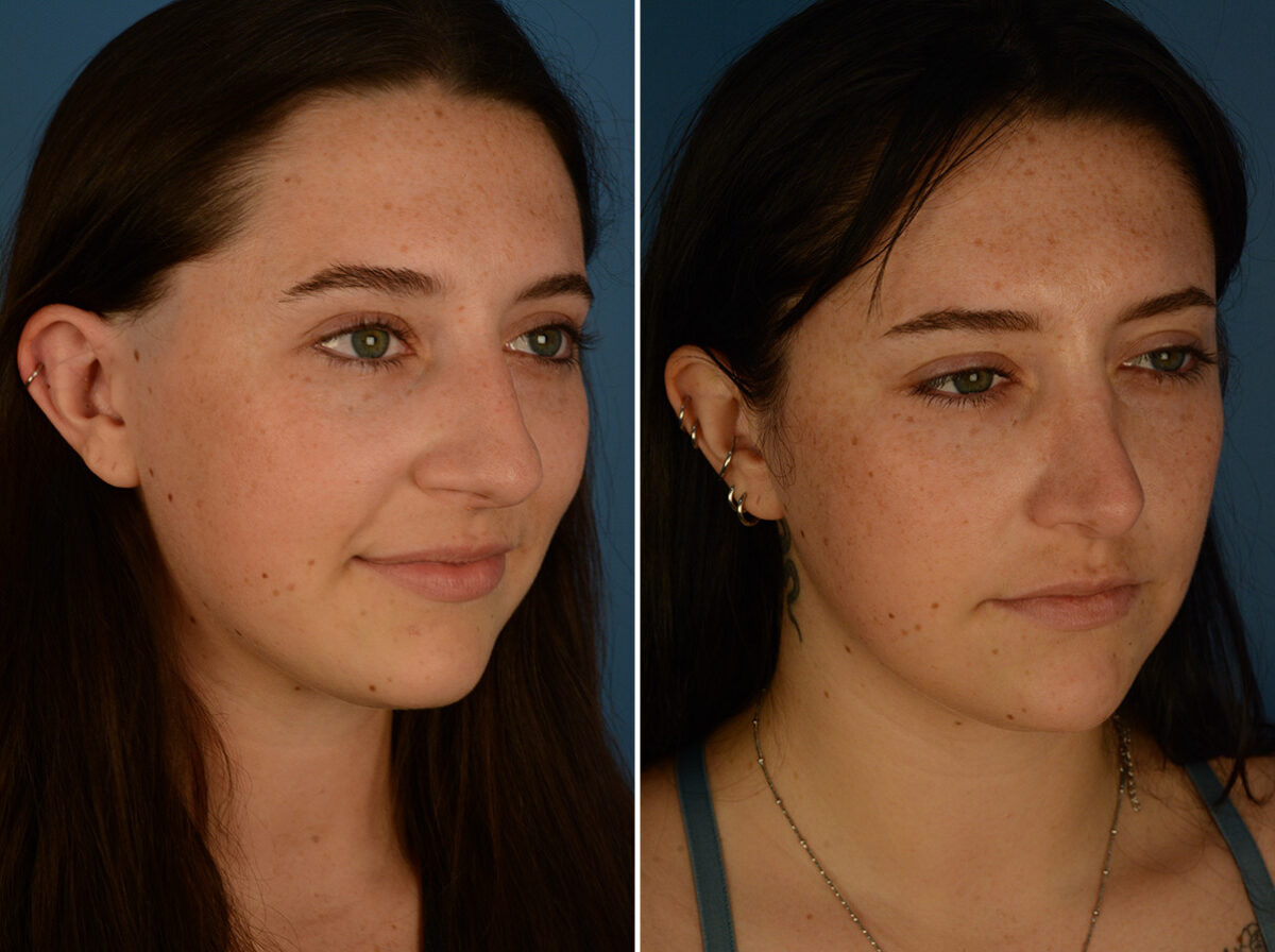 Rhinoplasty Before and After Photos in Naples, FL, Patient 29794