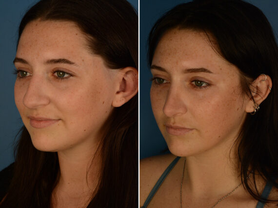 Rhinoplasty Before and After Photos in Naples, FL, Patient 29794