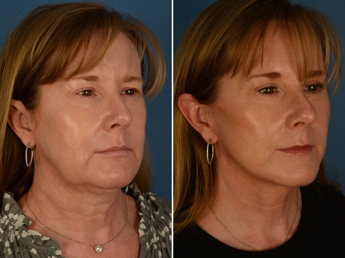 The UpLift™ Lower Face and Neck Lift Before and After Photos in Naples, FL, Patient 29816
