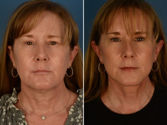 The UpLift™ Lower Face and Neck Lift Before and After Photos in Naples, FL, Patient 29816