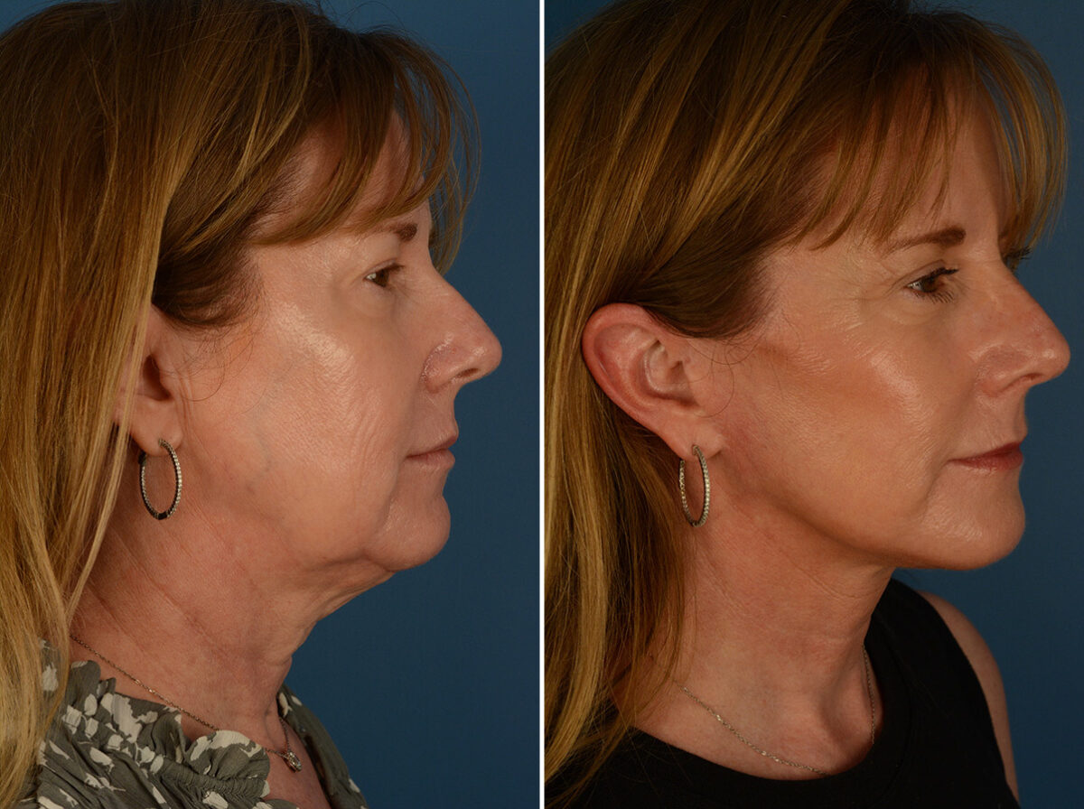 The UpLift™ Lower Face and Neck Lift Before and After Photos in Naples, FL, Patient 29816