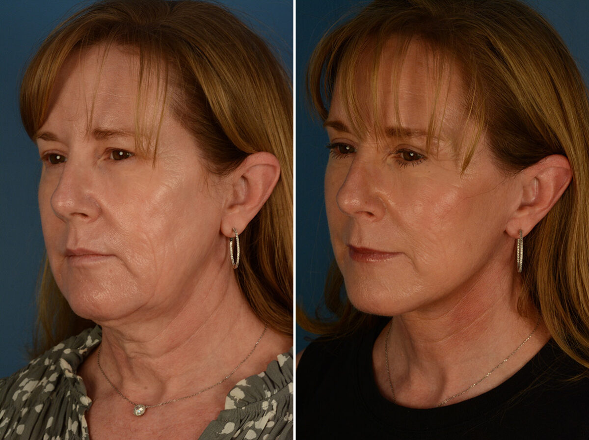 The UpLift™ Lower Face and Neck Lift Before and After Photos in Naples, FL, Patient 29816