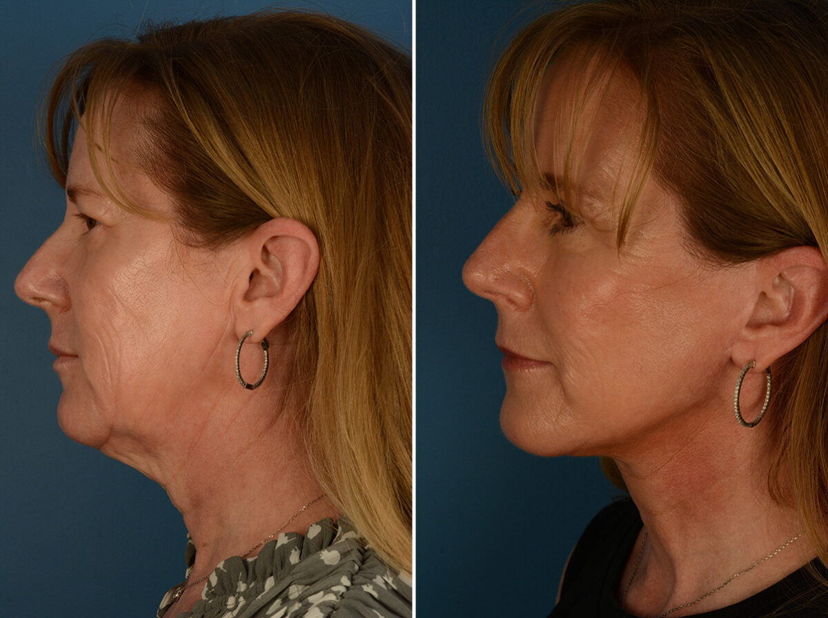 The UpLift™ Lower Face and Neck Lift Before and After Photos in Naples, FL, Patient 29816