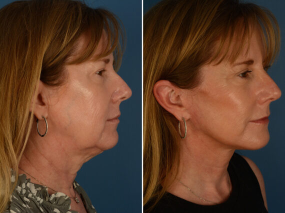 The UpLift™ Lower Face and Neck Lift Before and After Photos in Naples, FL, Patient 29816