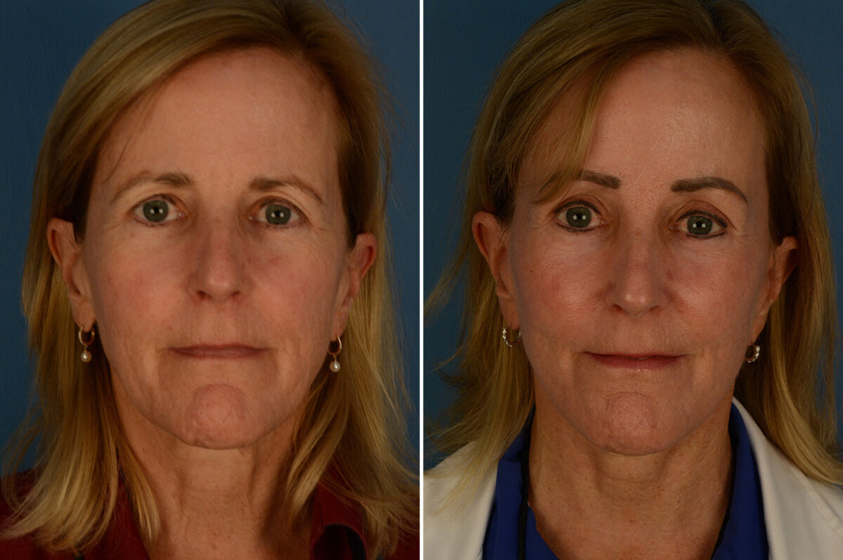 The UpLift™ Lower Face and Neck Lift Before and After Photos in Naples, FL, Patient 30216