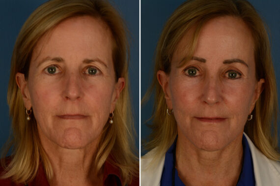 The UpLift™ Lower Face and Neck Lift Before and After Photos in Naples, FL, Patient 30216
