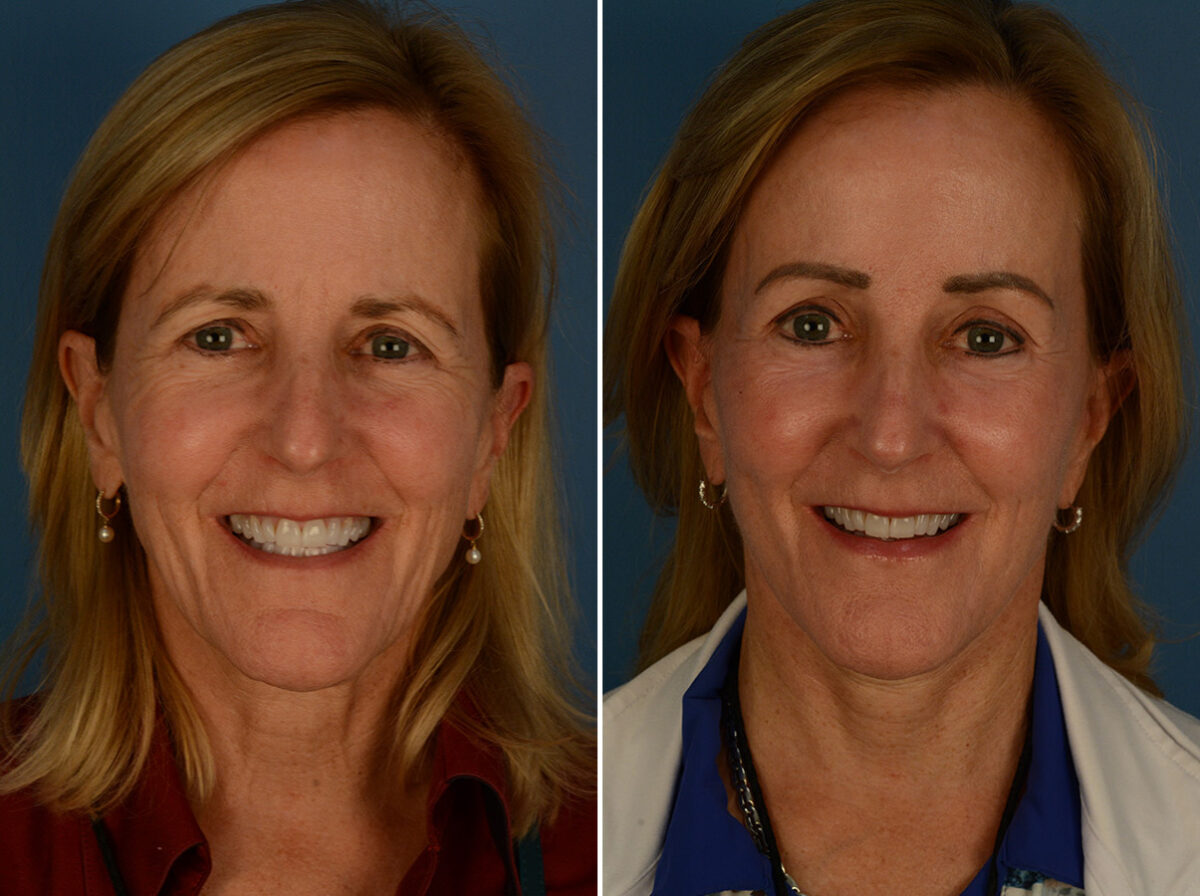 The UpLift™ Lower Face and Neck Lift Before and After Photos in Naples, FL, Patient 30216