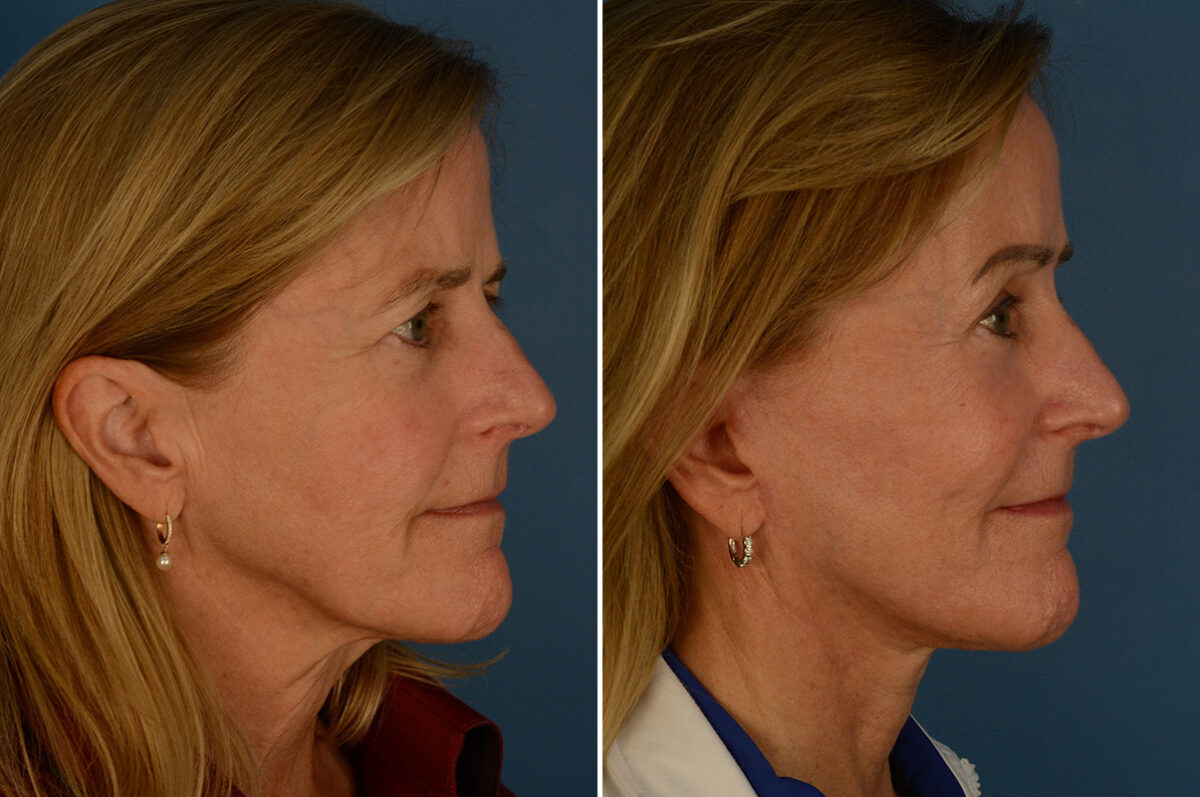 The UpLift™ Lower Face and Neck Lift Before and After Photos in Naples, FL, Patient 30216