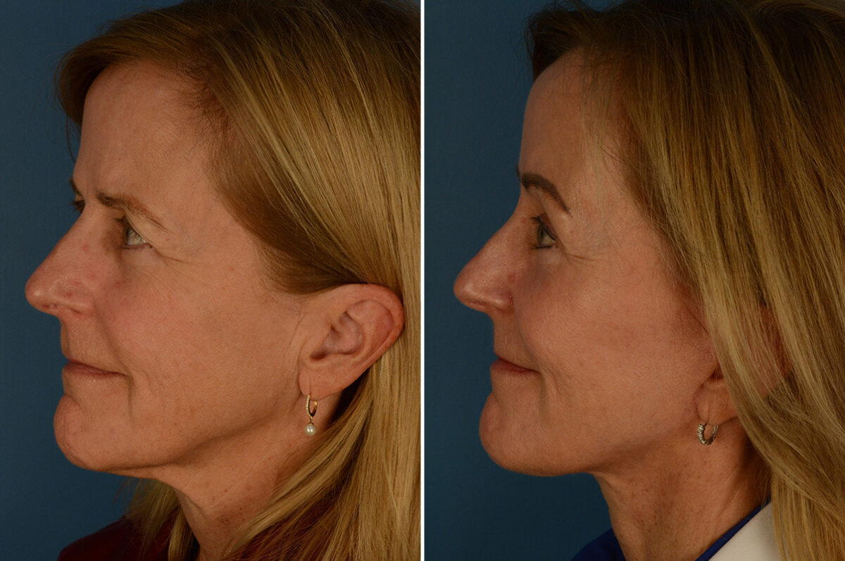 The UpLift™ Lower Face and Neck Lift Before and After Photos in Naples, FL, Patient 30216