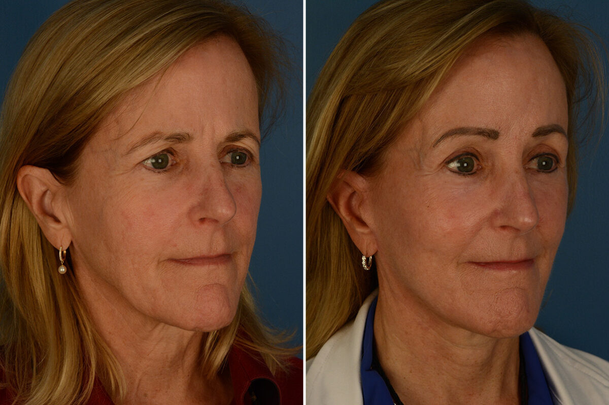 The UpLift™ Lower Face and Neck Lift Before and After Photos in Naples, FL, Patient 30216