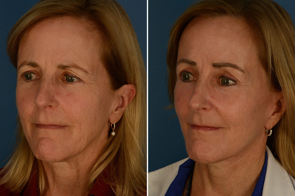 The UpLift™ Lower Face and Neck Lift Before and After Photos in Naples, FL, Patient 30216