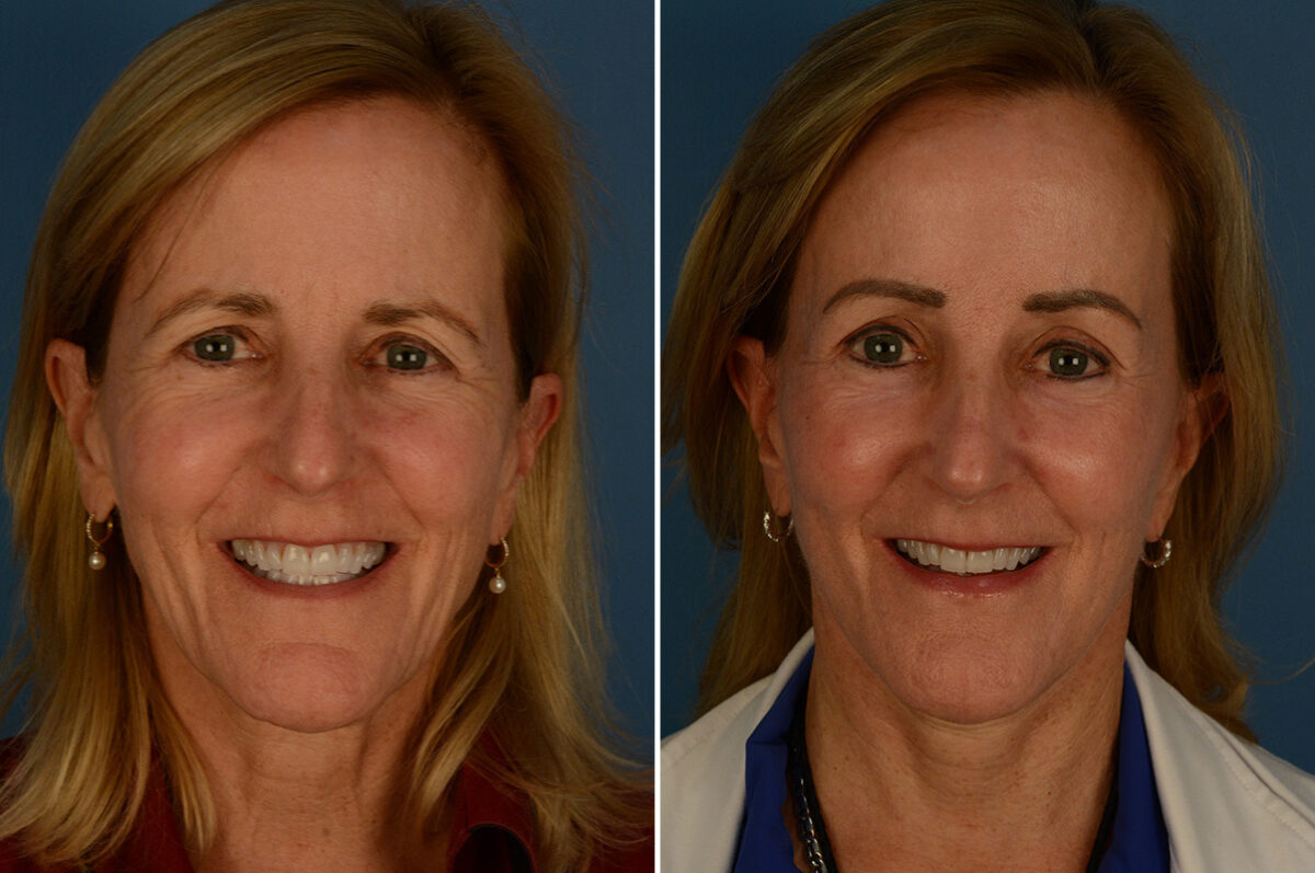 The UpLift™ Lower Face and Neck Lift Before and After Photos in Naples, FL, Patient 30216