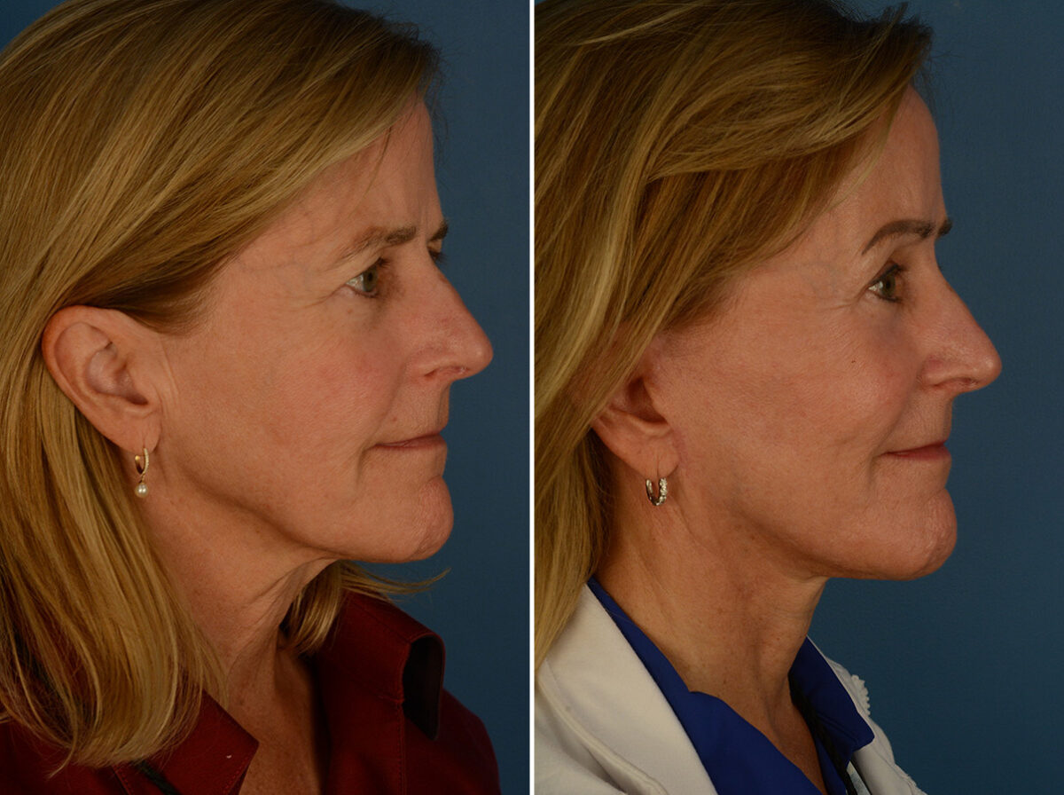 The UpLift™ Lower Face and Neck Lift Before and After Photos in Naples, FL, Patient 30216