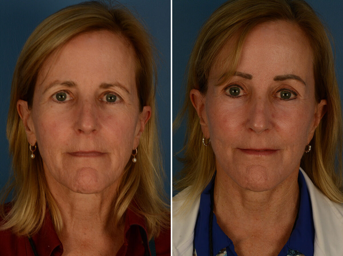 The UpLift™ Lower Face and Neck Lift Before and After Photos in Naples, FL, Patient 30216
