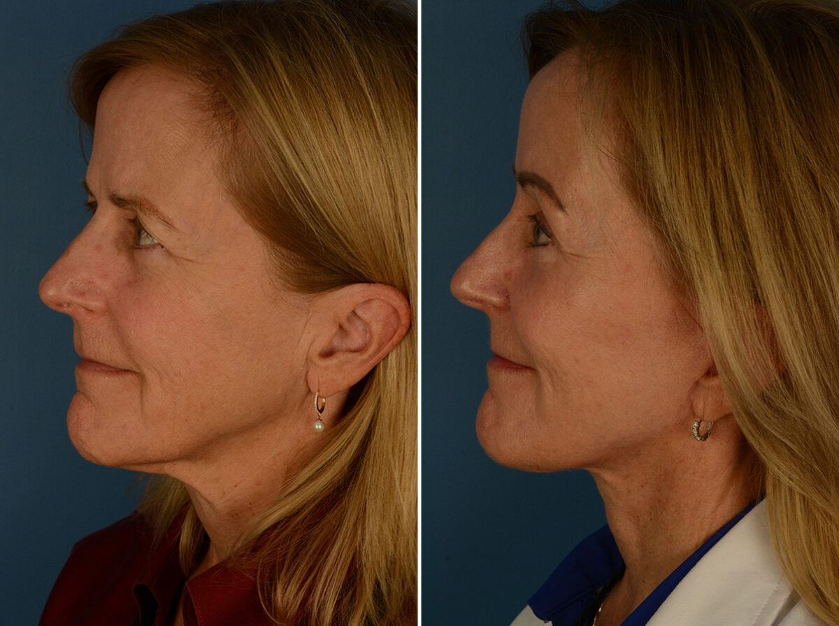 The UpLift™ Lower Face and Neck Lift Before and After Photos in Naples, FL, Patient 30216