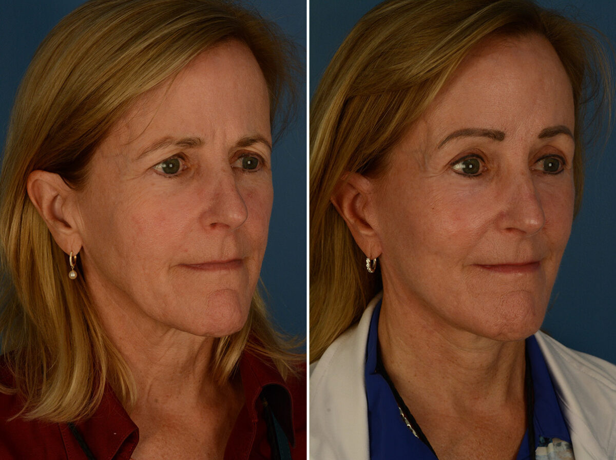 The UpLift™ Lower Face and Neck Lift Before and After Photos in Naples, FL, Patient 30216