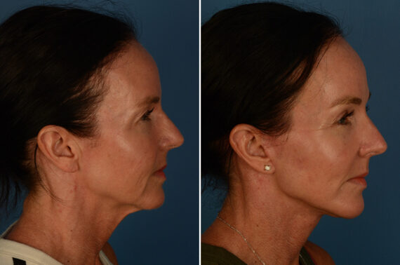 Blepharoplasty Before and After Photos in Naples, FL, Patient 30236