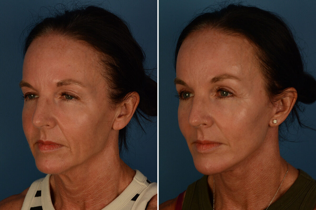 Blepharoplasty Before and After Photos in Naples, FL, Patient 30236