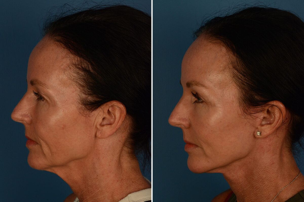 Blepharoplasty Before and After Photos in Naples, FL, Patient 30236