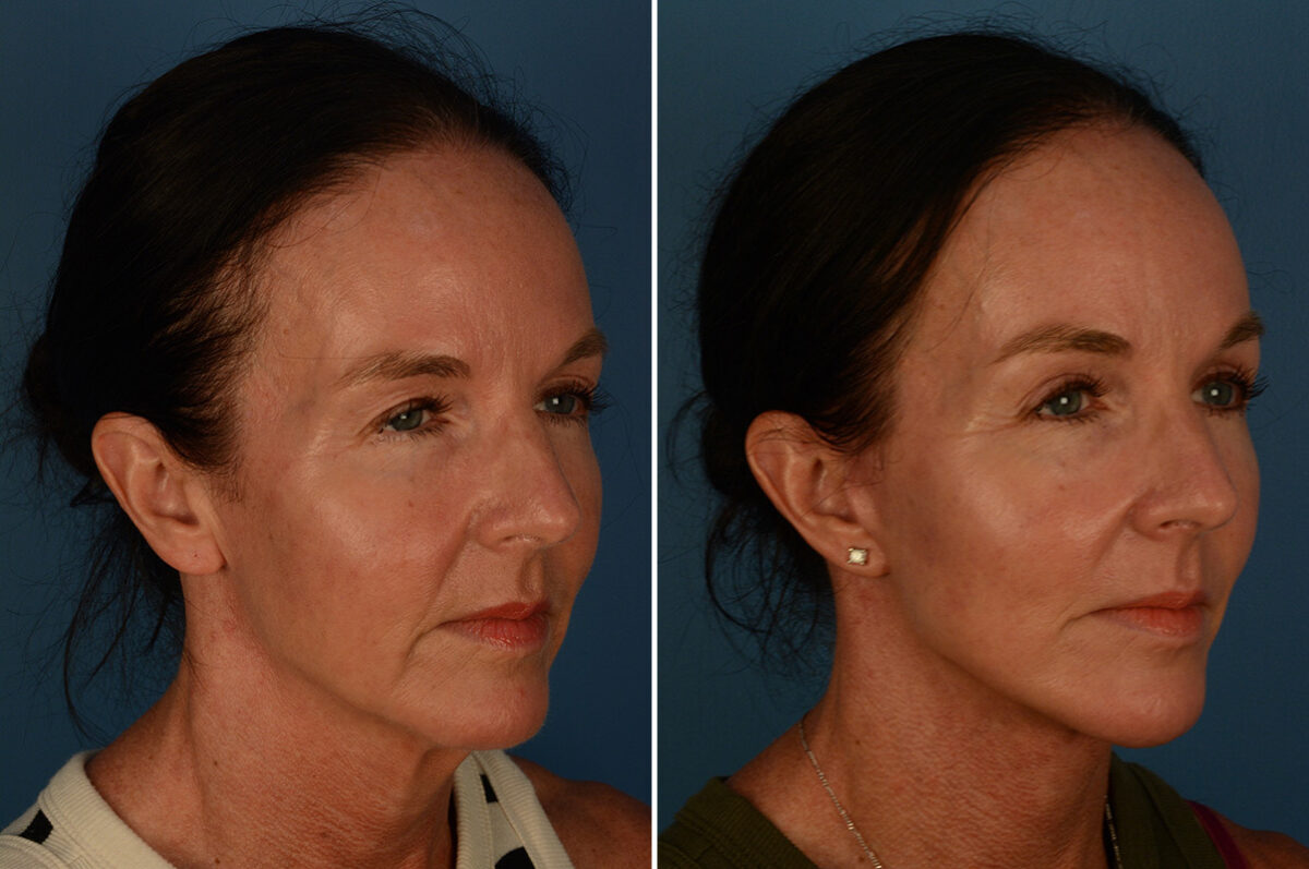 Blepharoplasty Before and After Photos in Naples, FL, Patient 30236