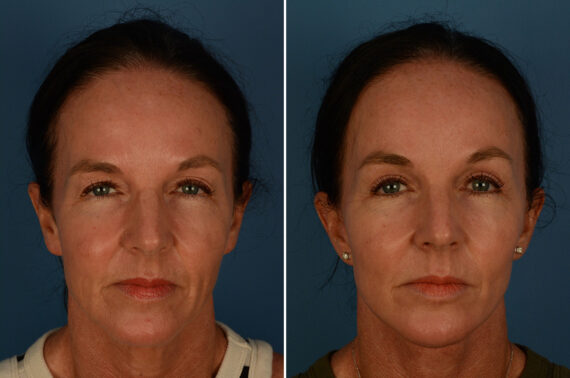 Blepharoplasty Before and After Photos in Naples, FL, Patient 30236