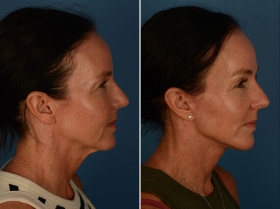 Blepharoplasty Before and After Photos in Naples, FL, Patient 30236