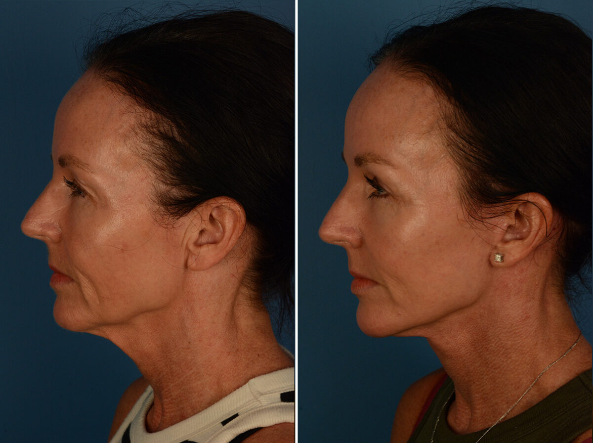 Blepharoplasty Before and After Photos in Naples, FL, Patient 30236