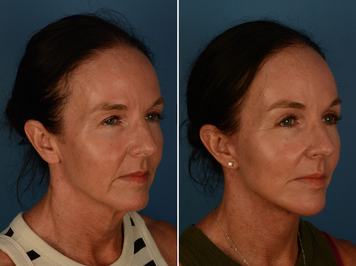 Blepharoplasty Before and After Photos in Naples, FL, Patient 30236