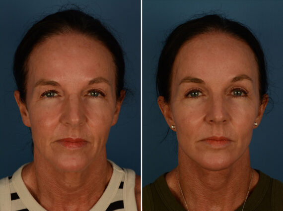 Blepharoplasty Before and After Photos in Naples, FL, Patient 30236