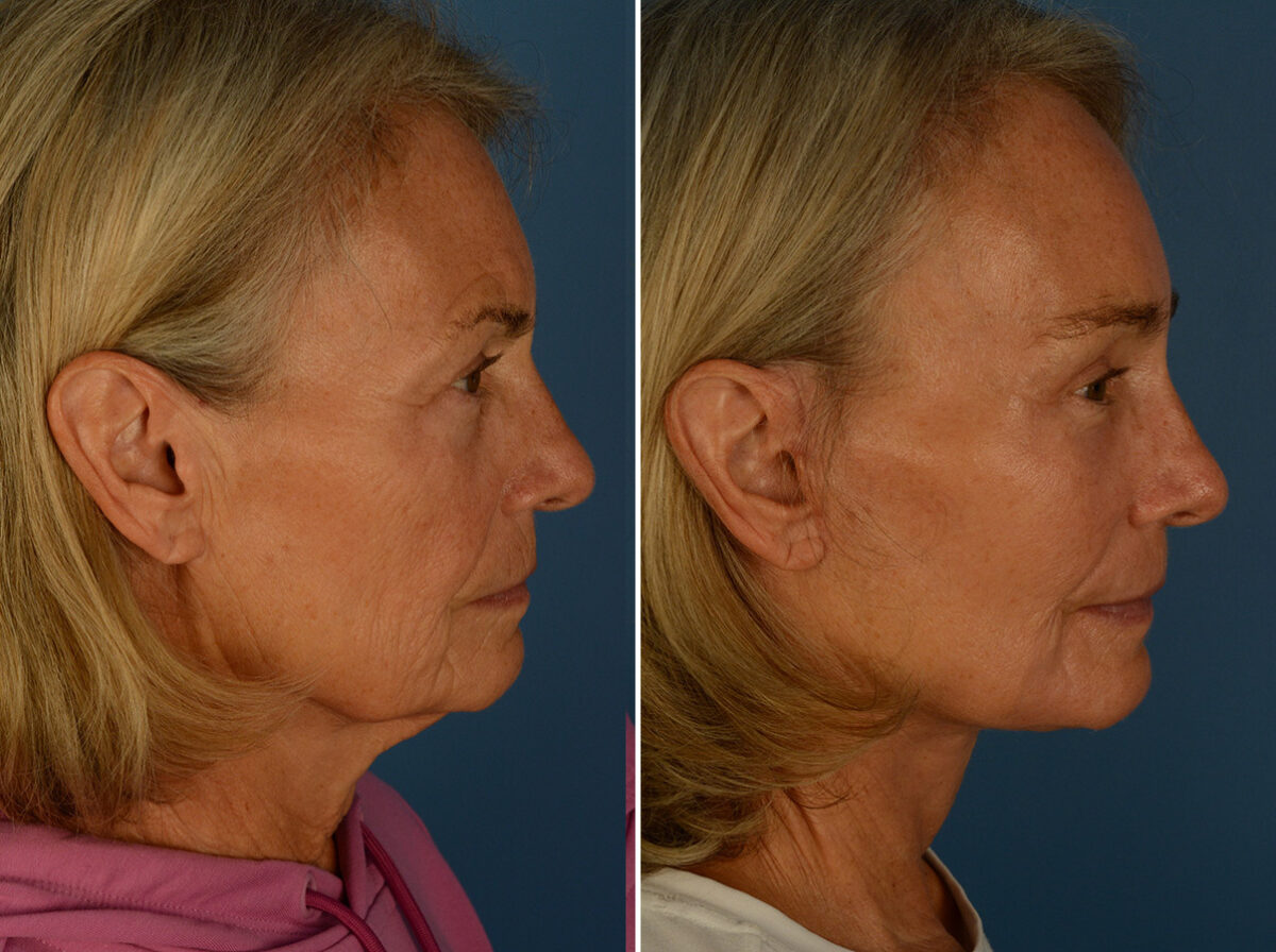 Endoscopic Facelift Before and After Photos in Naples, FL, Patient 30452