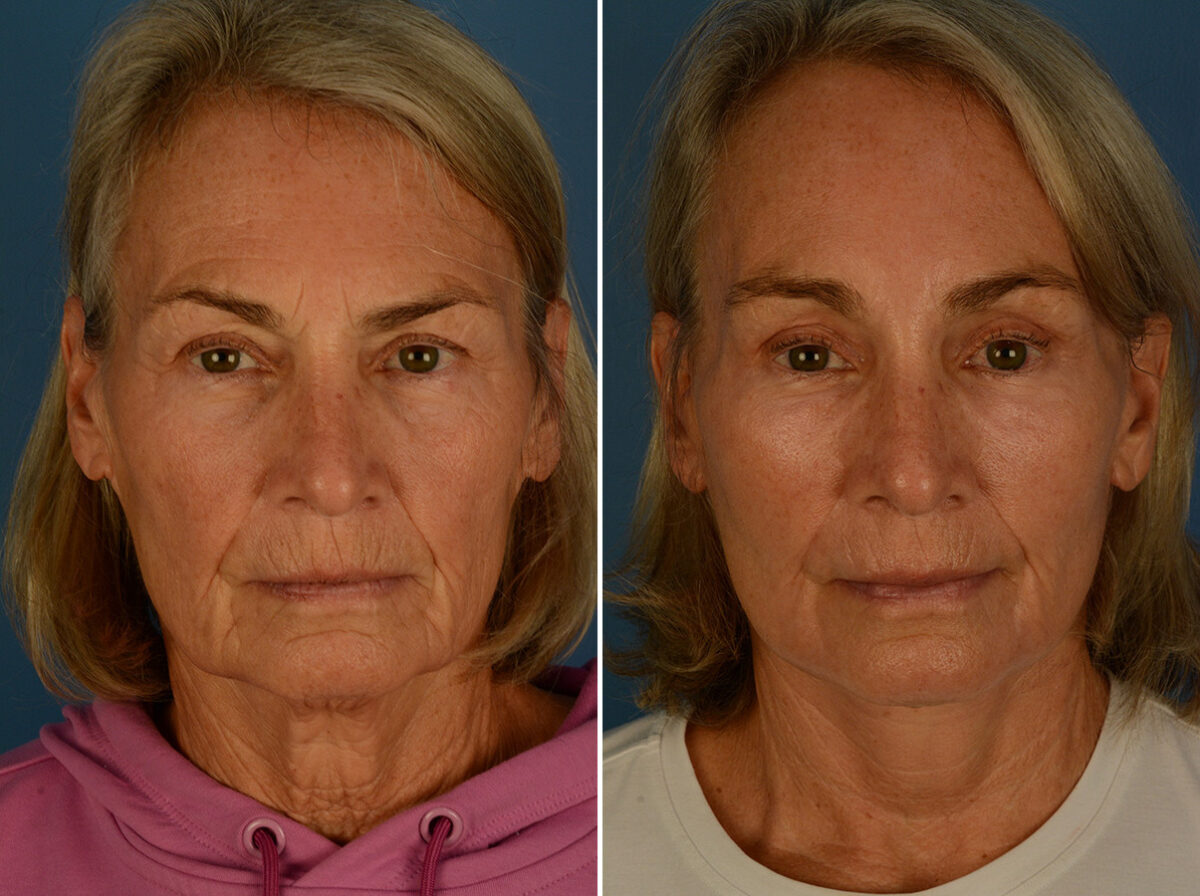 Endoscopic Facelift Before and After Photos in Naples, FL, Patient 30452