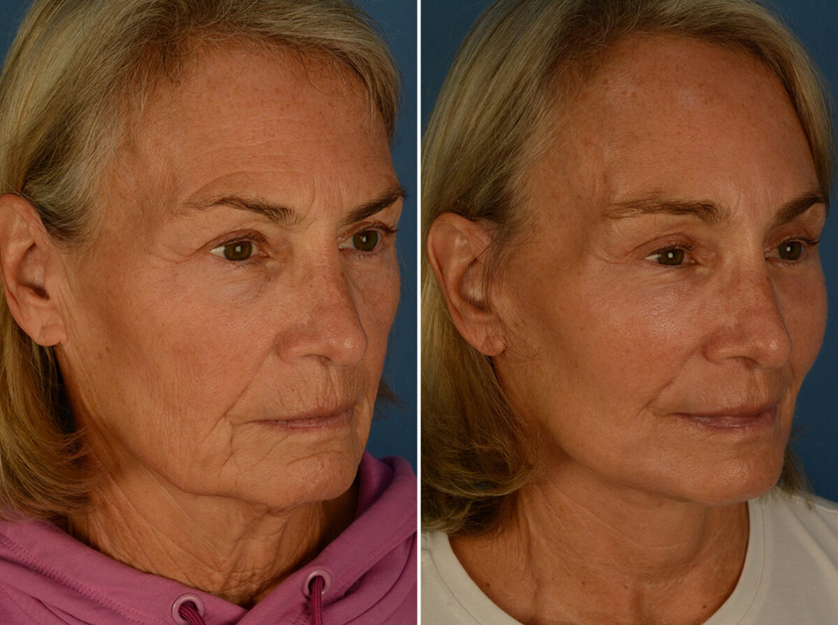 Endoscopic Facelift Before and After Photos in Naples, FL, Patient 30452