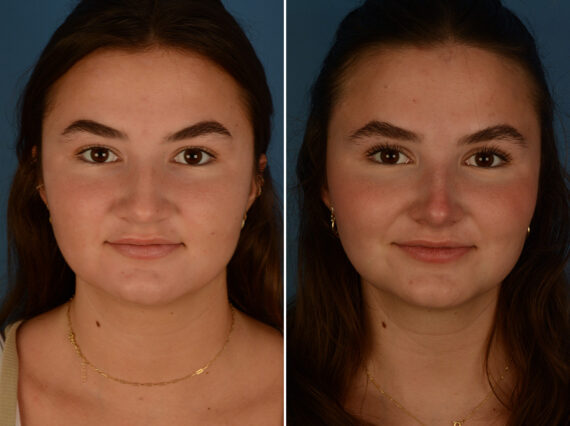 Rhinoplasty Before and After Photos in Naples, FL, Patient 30466