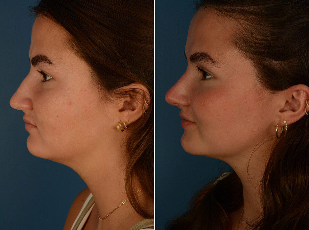 Rhinoplasty Before and After Photos in Naples, FL, Patient 30466