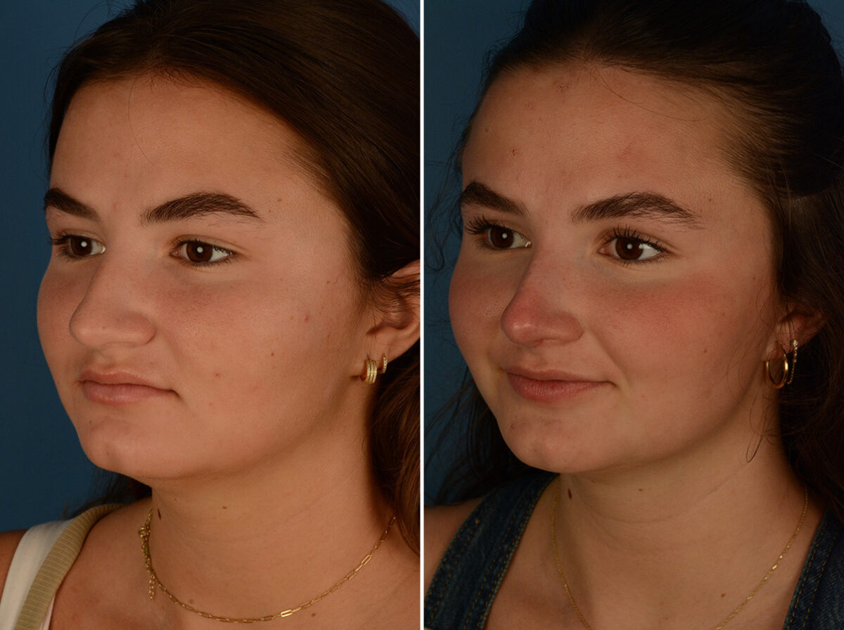 Rhinoplasty Before and After Photos in Naples, FL, Patient 30466