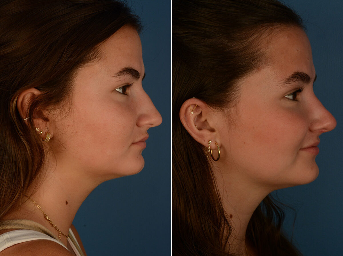 Rhinoplasty Before and After Photos in Naples, FL, Patient 30466