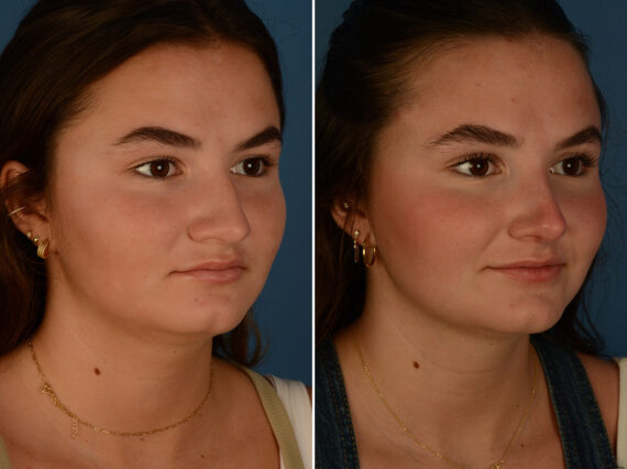 Rhinoplasty Before and After Photos in Naples, FL, Patient 30466