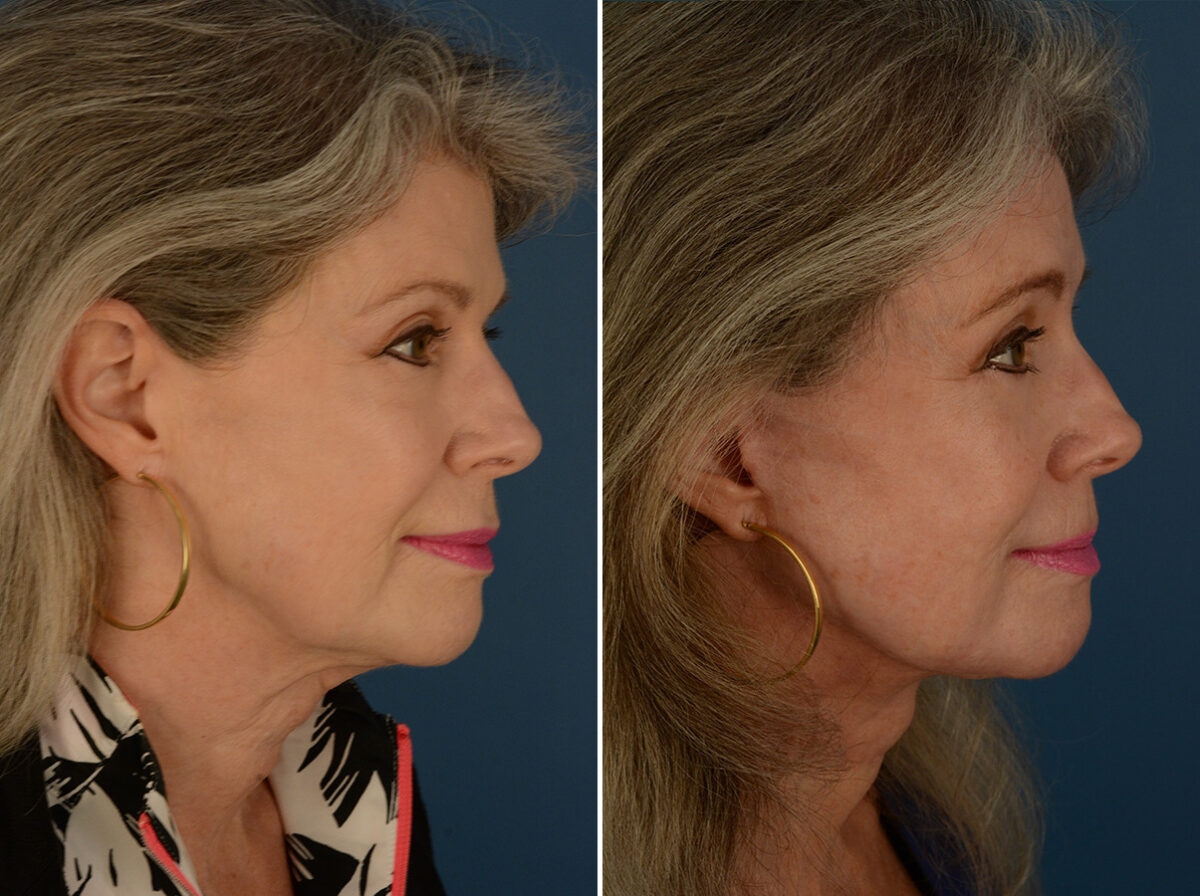 Endoscopic Facelift Before and After Photos in Naples, FL, Patient 30482